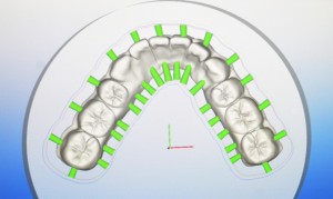 CAD/CAM Design | Phoenix Dental Lab